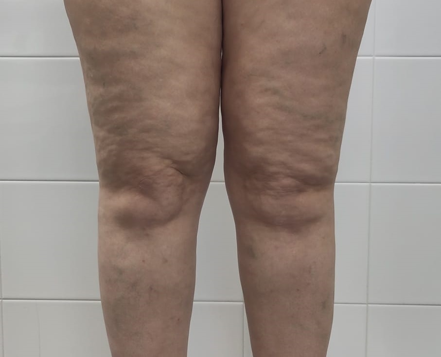 Lipedema vs Cellulite: Key Differences You Need to Know Today